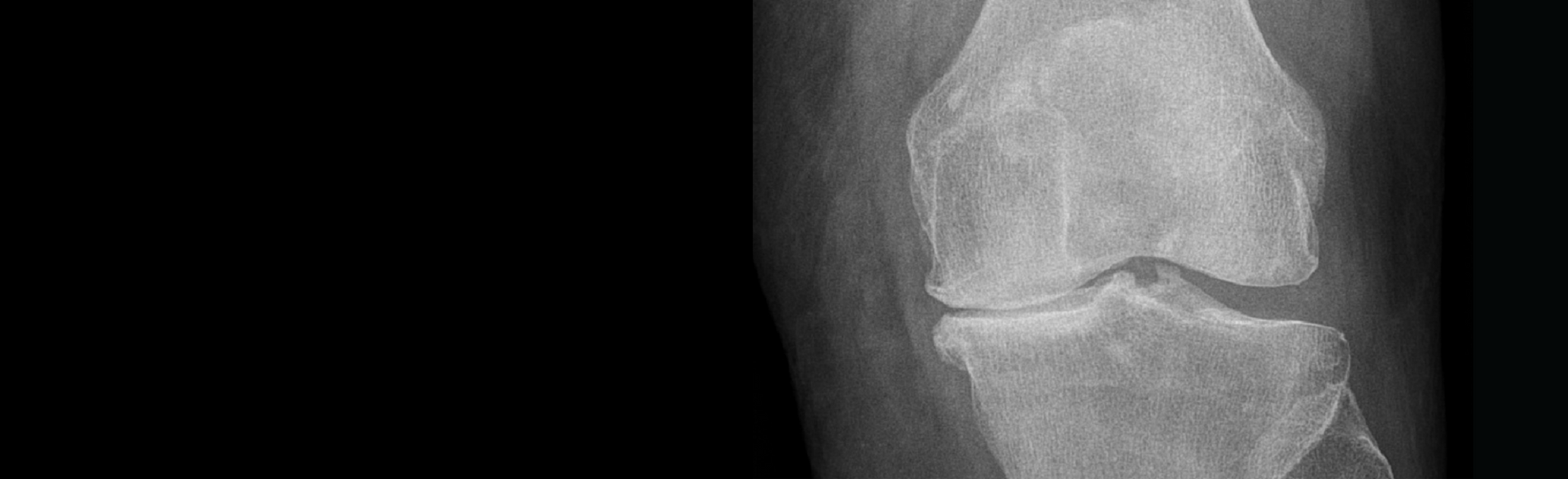 Knee Osteoarthritis (OA)